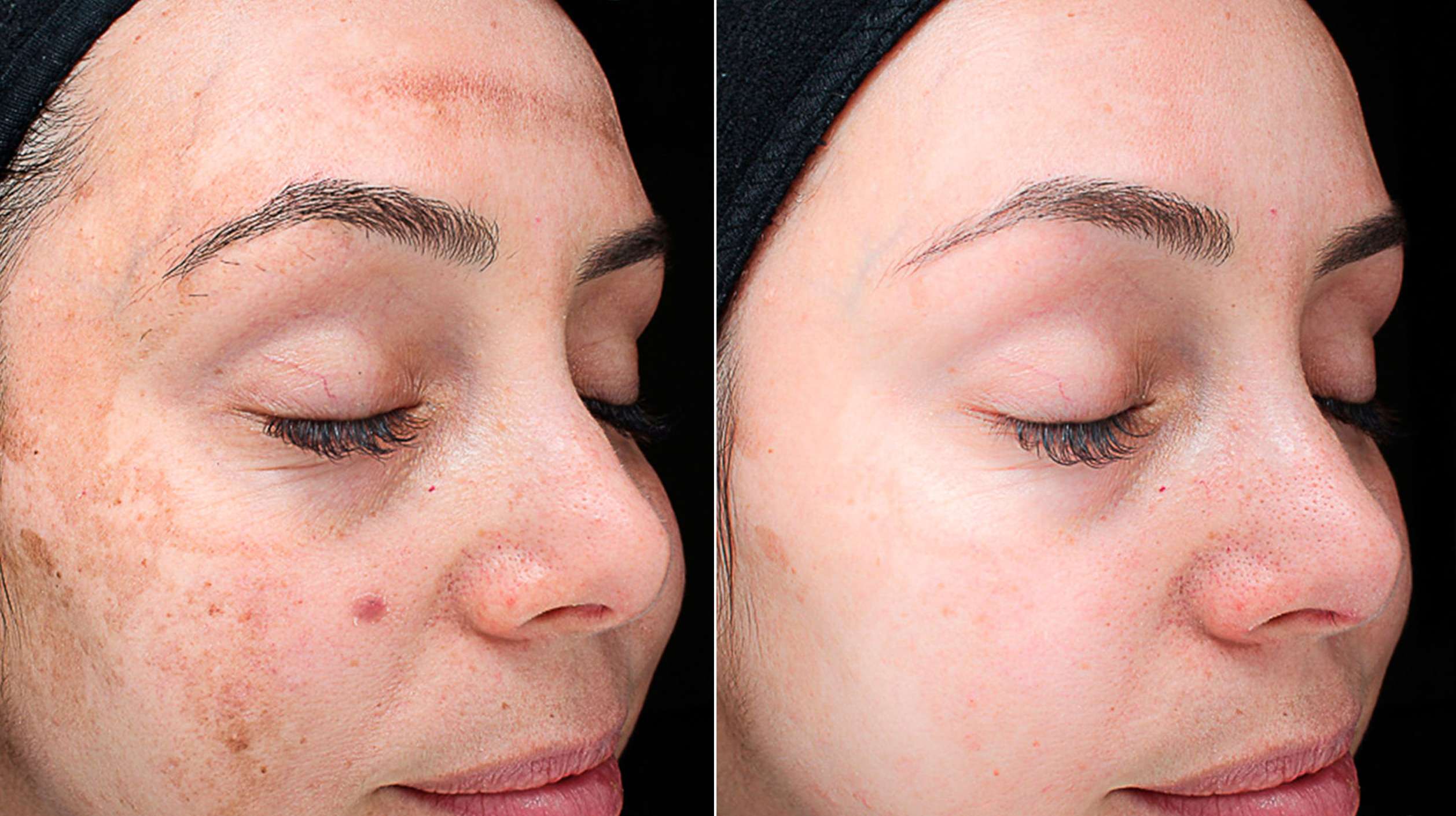 Pigmentation treatment